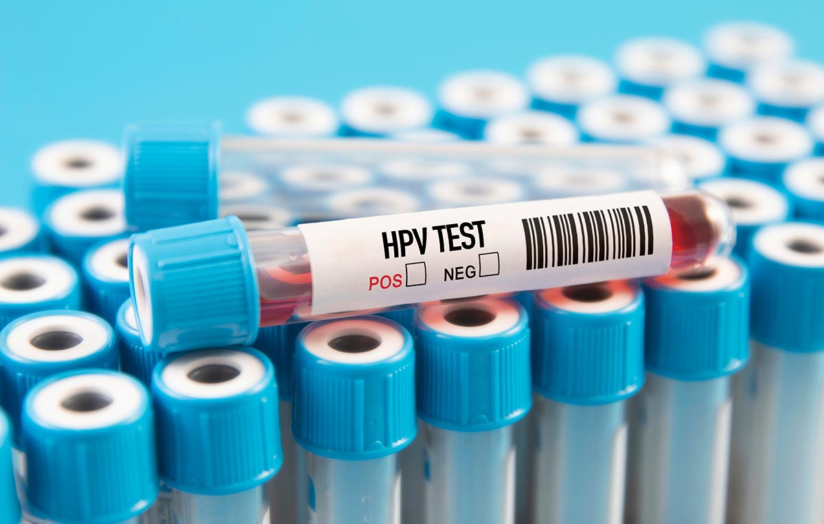 Como detectar HPV: a importância do exame de captura híbrida na saúde da mulher